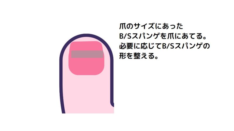巻き爪BSブレイス.クラシックマグネットプロセット／BSスパンゲ 