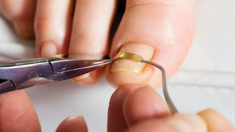 手術以外にもある陥入爪の治療方法