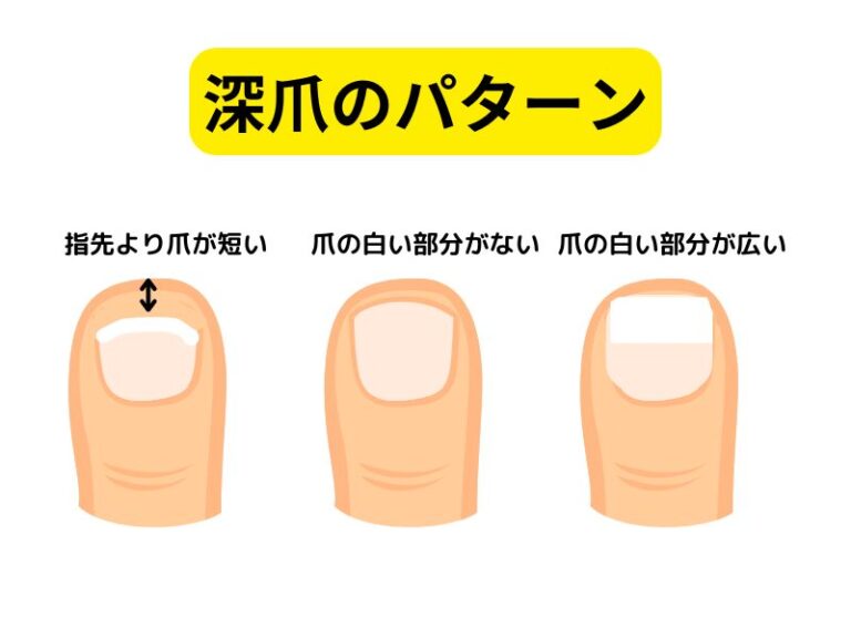 深爪の基準はどこから?切り過ぎがダメな理由や正常に戻す方法を徹底解説 | 三鷹市の巻き爪治療なら|巻爪専門三鷹院